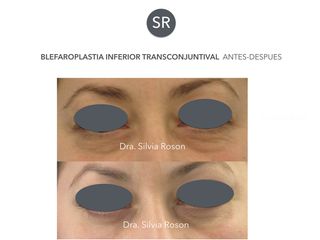 Antes y después Blefaroplastia inferior transconjuntival 