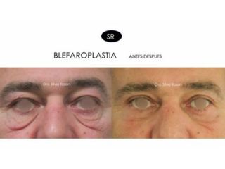 Antes y después Blefaroplastia 
