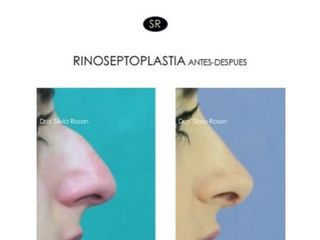 Antes y después Rinoplastia