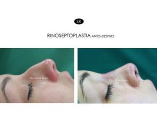 Antes y después Rinoplastia