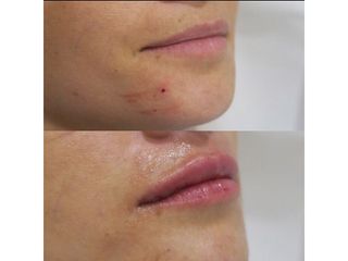 Aumento de labios - Dra. Silvia Roson