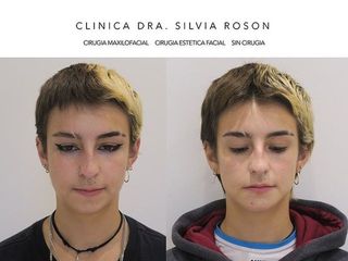 Mentoplastia - Dra. Silvia Roson