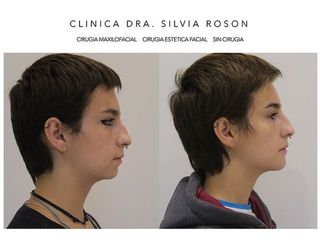 Mentoplastia - Dra. Silvia Roson