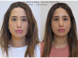 Rinoplastia - Dra. Silvia Roson