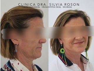 Lifting - Dra. Silvia Roson