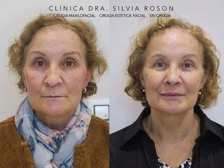 Lifting - Dra. Silvia Roson