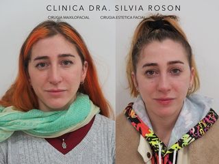 Rinoplastia - Dra. Silvia Roson