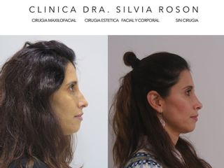 Rinoplastia - Dra. Silvia Roson