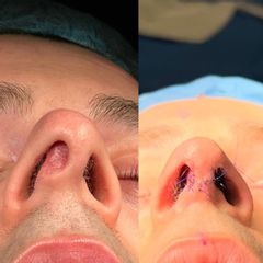 Rinoplastia - Dra. Silvia Roson