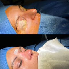Rinoplastia - Clinica Silvia Roson