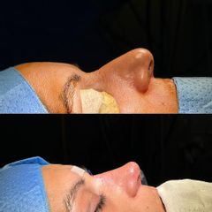 Rinoplastia - Clinica Silvia Roson