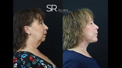Liposucción de papada - Clinica Silvia Roson
