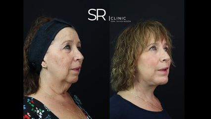 Liposucción de papada - Clinica Silvia Roson