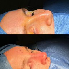 Rinoplastia - Clinica Silvia Roson