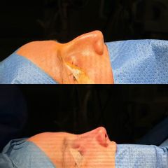 Rinoplastia - Clinica Silvia Roson