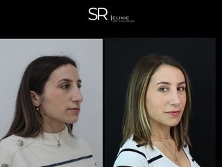 Rinoplastia - Clinica Silvia Roson