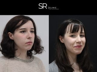 Rinoplastia - Clinica Silvia Roson