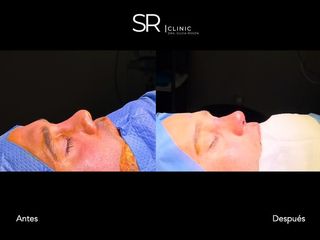 Rinoplastia - Clinica Silvia Roson
