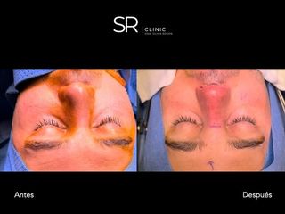 Rinoplastia - Clinica Silvia Roson