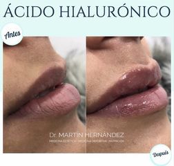 Aumento de labios - Dr. Martín Hernández