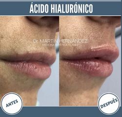 Aumento de labios - Dr. Martín Hernández