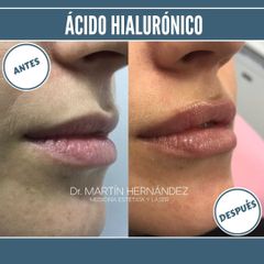 Aumento de labios - Dr. Martín Hernández