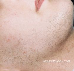 Antes pelo fuerte en la cara de una mujer