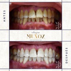 Blanqueamiento dental - Clínica Dra. Muñoz