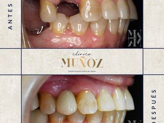 Implantes dentales - 821703