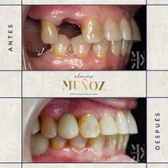 Implantes dentales - Clínica Dra. Muñoz