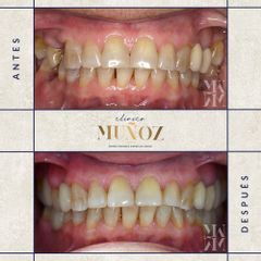 Blanqueamiento dental - Clínica Dra. Muñoz