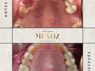 Implantes dentales - 821710
