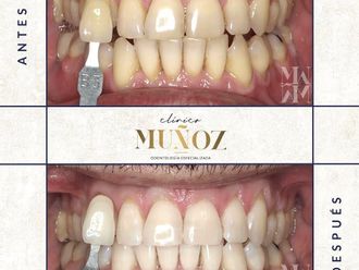 Blanqueamiento dental - 821712