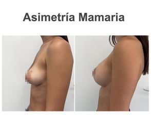 Mastopexia - Instituto de Cirugía Plástica y Reconstructiva del Mediterráneo