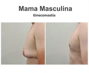 Ginecomastia - Instituto de Cirugía Plástica y Reconstructiva del Mediterráneo