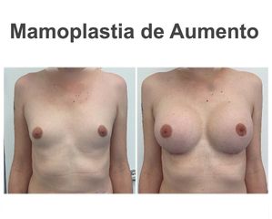 Aumento de pecho - Instituto de Cirugía Plástica y Reconstructiva del Mediterráneo
