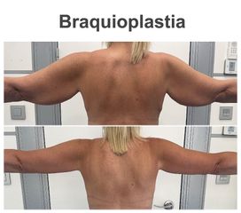 Braquioplastia - Instituto de Cirugía Plástica y Reconstructiva del Mediterráneo