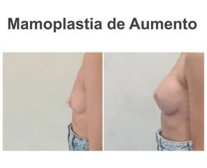Aumento de pecho - Instituto de Cirugía Plástica y Reconstructiva del Mediterráneo