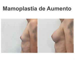 Aumento de pecho - Instituto de Cirugía Plástica y Reconstructiva del Mediterráneo