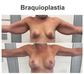 Braquioplastia - Instituto de Cirugía Plástica y Reconstructiva del Mediterráneo