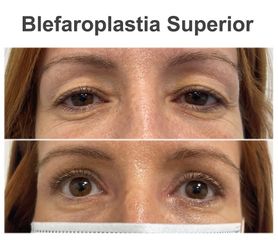 Blefaroplastia - Instituto de Cirugía Plástica y Reconstructiva del Mediterráneo