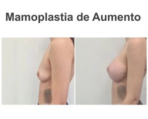 Aumento de pecho - Instituto de Cirugía Plástica y Reconstructiva del Mediterráneo