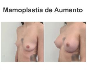 Aumento de pecho - Instituto de Cirugía Plástica y Reconstructiva del Mediterráneo