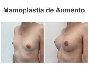 Aumento de pecho - Instituto de Cirugía Plástica y Reconstructiva del Mediterráneo