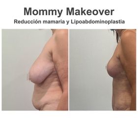 Lipoescultura - Instituto de Cirugía Plástica y Reconstructiva del Mediterráneo