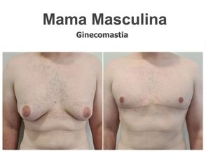 Ginecomastia - Instituto de Cirugía Plástica y Reconstructiva del Mediterráneo