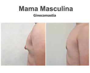 Ginecomastia - Instituto de Cirugía Plástica y Reconstructiva del Mediterráneo