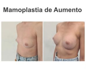 Aumento de pecho - Instituto de Cirugía Plástica y Reconstructiva del Mediterráneo