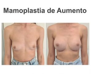 Aumento de pecho - Instituto de Cirugía Plástica y Reconstructiva del Mediterráneo