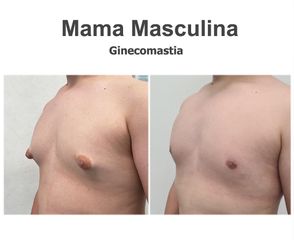Ginecomastia - Instituto de Cirugía Plástica y Reconstructiva del Mediterráneo